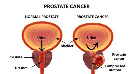Prostate cancer, 3D illustration showing normal prostate gland and presence of tumor inside prostate...