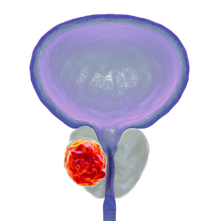 Prostate cancer, 3D illustration showing presence of tumor inside prostate gland which compresses...