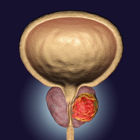 Prostate cancer, 3D illustration showing presence of tumor inside prostate gland which compresses...