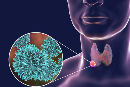 Thyroid cancer. 3D illustration showing thyroid gland with tumor inside human body and closeup view...
