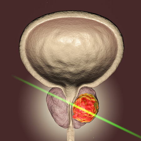 Conceptual image for prostate cancer laserotherapy, 3D illustration showing destruction of a tumor inside prostate gland with laserの写真素材