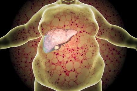 Obese man with fatty liver on background with micrograph of liver steatosis, 3D illustration. Conceptual image for non-alcoholic fatty liver diseaseの写真素材
