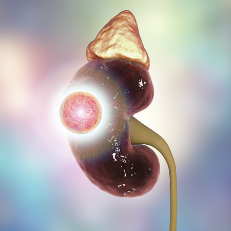 Treatment of kidney cancer, conceptual image. 3D illustration. Kidney tumour disease therapy and...