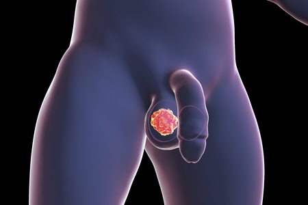 Testicular cancer medical concept. Cancer of testis, 3D illustrationの写真素材