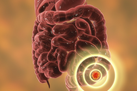 Colorectal cancer awareness medical concept. Concept of cancer treatment and prevention, 3D...