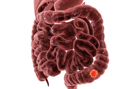 Colorectal cancer awareness medical concept, 3D illustration showing cancerous tumor inside large...