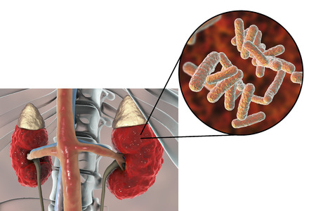 Pyelonephritis, medical concept, and close-up view of bacteria, causative agent of kidney infection,...