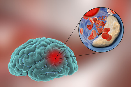 Ischemic brain stroke concept, 3D illustration showing human brain and close-up view of blood vessel obturated with cholesterol plaqueの写真素材