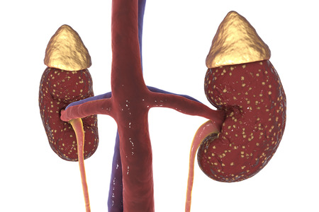 Pyelonephritis, medical concept, 3D illustration showing presence of purulent blisters in kidney tissueの写真素材