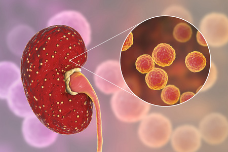 Acute pyelonephritis, medical concept, and close-up view of bacteria Enterococcus, the common...