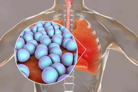 Pneumococcal pneumonia, medical concept. 3D illustration showing bacteria Streptococcus pneumoniae...