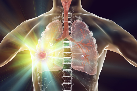 Lung cancer treatment and prevention concept, 3D illustrationの写真素材