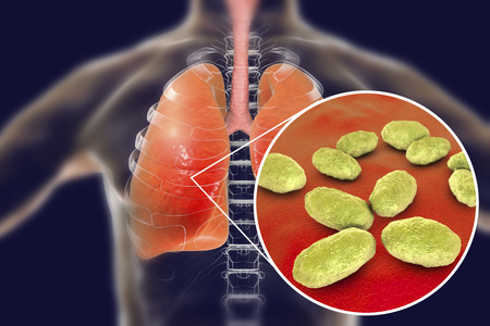 Pneumonia caused by Haemophilus influenzae bacteria, medical concept, 3D illustration. Gram-negative...