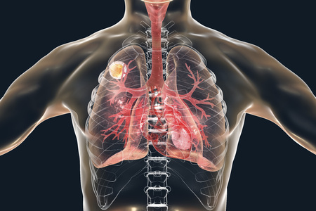 Aspergilloma of the lung, 3D illustration. Also known as mycetoma, or fungus ball, a lesion produced by fungi Aspergillus in immunocompromised patientsの写真素材