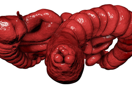 Hemorrhoids, bottom view of hemorrhoic nodules inside anus, large and small intestine are also...