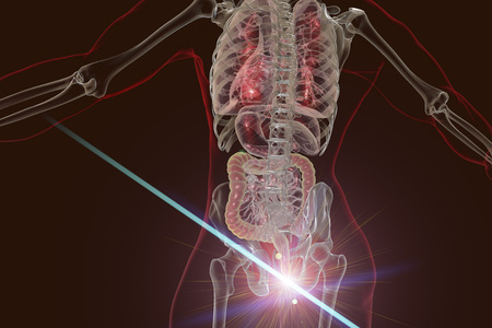Hemorrhoids treatment and prevention concept, 3D illustration