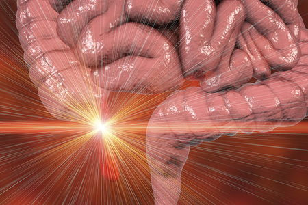 Laser surgery treatment of acute appendicitis, conceptual image, 3D illustration. Appendectomy