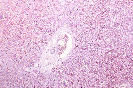 Acute hepatic congestion, light micrograph, an acute consequence of right heart failureの写真素材