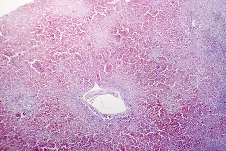 Chronic hepatic congestion, light micrograph, a congestion caused by chronic right heart failureの写真素材