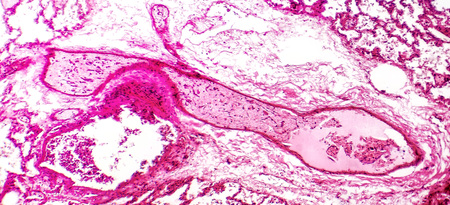 Transparent thrombosis, light micrograph, hematoxylin and eosin stainingの写真素材