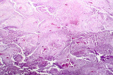 Histopathology of lymph nodal tuberculosis, light micrograph, hematoxylin and eosin stainingの写真素材