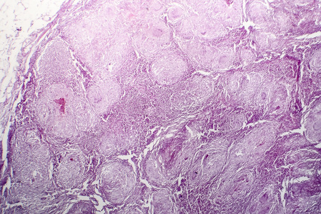 Histopathology of lymph nodal tuberculosis, light micrograph, hematoxylin and eosin stainingの写真素材