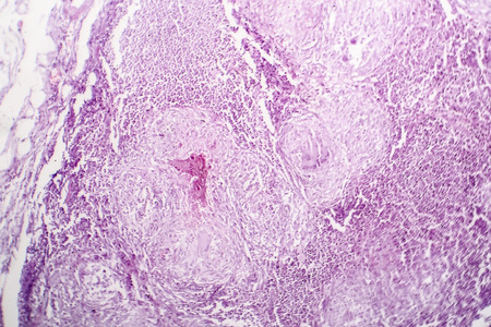 Histopathology of lymph nodal tuberculosis, light micrograph, hematoxylin and eosin stainingの写真素材