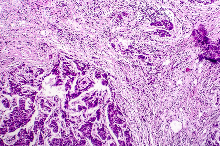 Lymph node metastasis, light micrograph of cancer that has spread to a lymph nodeの写真素材