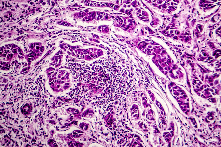 Lymph node metastasis, light micrograph of cancer that has spread to a lymph nodeの写真素材