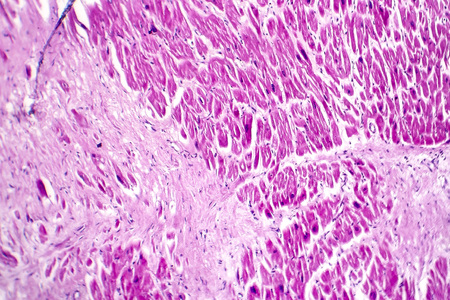 Acute myocardial infarction, histology of heart tissue, light micrograph. Area of infarct is paler than than the relatively viable area of heart muscleの写真素材