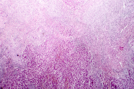 Histopathology of liver abscess, light micrograph, hematoxylin and eosin stainingの写真素材