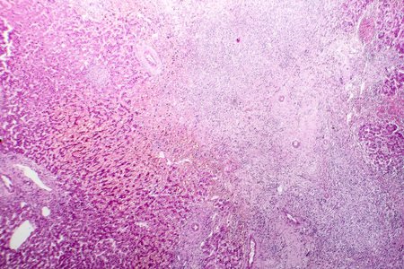 Histopathology of liver abscess, light micrograph, hematoxylin and eosin stainingの写真素材