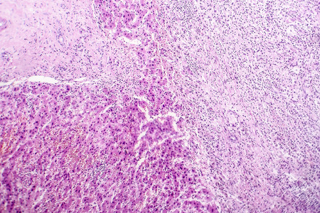 Histopathology of liver abscess, light micrograph, hematoxylin and eosin stainingの写真素材