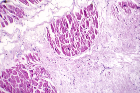 Acute myocardial infarction, histology of heart tissue, light micrograph. Area of infarct is paler than than the relatively viable area of heart muscleの写真素材