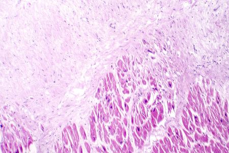 Acute myocardial infarction, histology of heart tissue, light micrograph. Area of infarct is paler than than the relatively viable area of heart muscleの写真素材