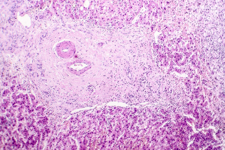 Histopathology of liver abscess, light micrograph, hematoxylin and eosin stainingの写真素材