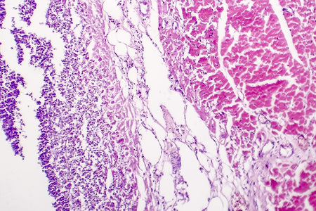 Histopathology of bacterial myocarditis, inflammatory heart disease, light micrographの写真素材