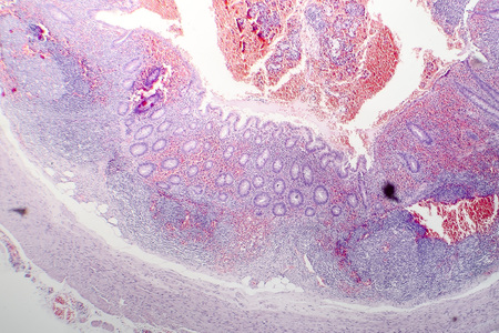 Histopathology of chronic appendicitis, light micrograph, photo under microscopeの写真素材