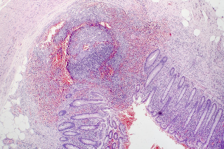 Histopathology of chronic appendicitis, light micrograph, photo under microscopeの写真素材