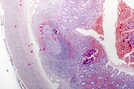 Histopathology of chronic appendicitis, light micrograph, photo under microscopeの写真素材