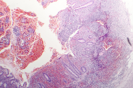 Histopathology of chronic appendicitis, light micrograph, photo under microscopeの写真素材