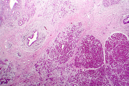 Acute hemorrhagic pancreatitis, light micrograph, hematoxylin and eosin stainingの写真素材