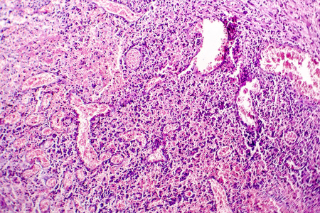 Histopathology of chronic cholecystitis, light micrograph, hematoxylin and eosin stainingの写真素材