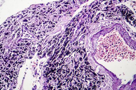 Smokers lung, histopathology, light micrograph showing accumulation of carbon particles in lung tissueの写真素材