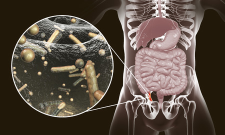 Acute appendicitis and close-up view of bacteria in appendix, the causative agent of appendicitis, 3D illustrationの写真素材