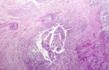Splenic infarction, light micrograph, photo under microscopeの写真素材