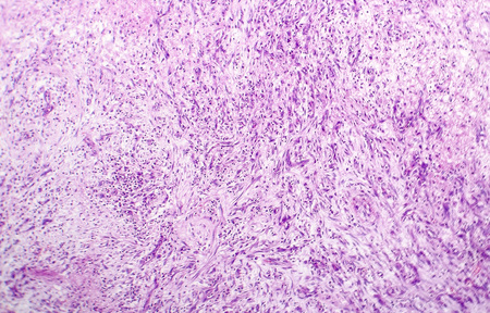Splenic infarction, light micrograph, photo under microscopeの写真素材