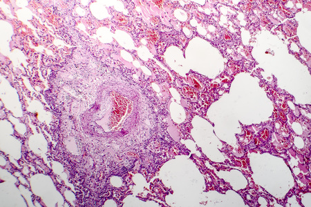 Chronic pulmonary congestion and edema, light micrographの写真素材
