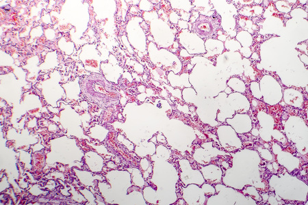Chronic pulmonary congestion and edema, light micrographの写真素材