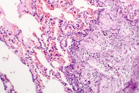 Chronic pulmonary congestion and edema, light micrographの写真素材